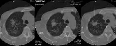 Image of CT scan needle biopsy
