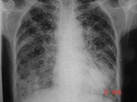 Image of CXR cancer