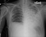 Image of CXR