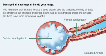 COPD COPD