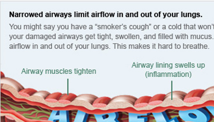 COPD COPD
