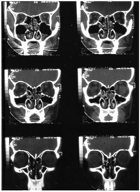 Image of CT Sinus which shows pansinusitis
