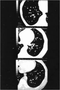 Image of HRCT Thorax demonstrating bronchiectasis of the left lower lobe