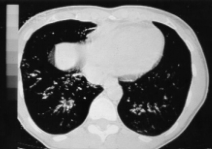 Image of HRCT Thorax demonstrating parenchymal tree-in-bud abnormalities of endobronchial tuberculosis