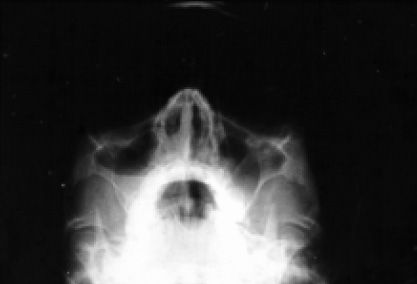 Image of Sinus X-ray demonstrating maxillary sinusitis with a fluid level in the right maxillary antrum